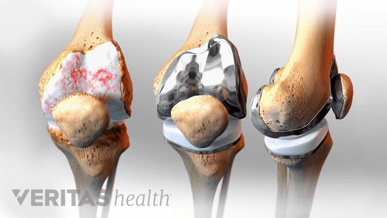 3 stages of a knee replacement. First inset shows a knee with degenerated cartilage, the second inset shows a replaced knee joint, the 3rd inset shows the replaced knee from the side