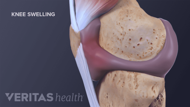 illustration showing swollen knee joint.