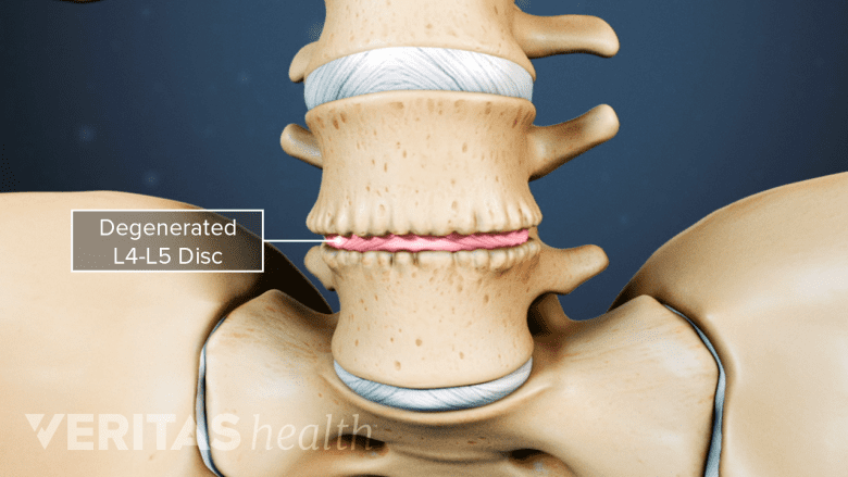 Illustration showing degenerated lumbar vertebra.