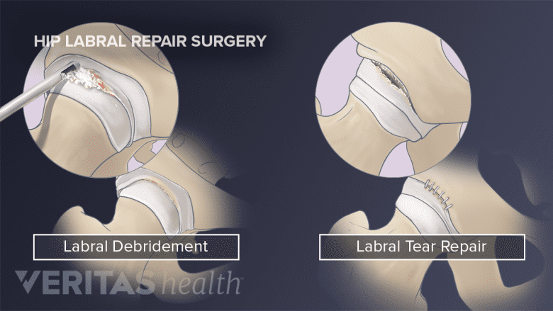 bpc 157 hip labral tear Bone Marrow Aspirate Treatment for the Hip's Tears The anterior labral test of