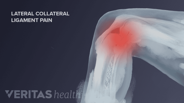 Illustration showing knee joint with diffuse red area in the knee joint indicating pain.