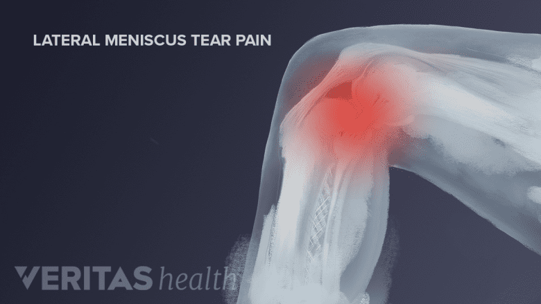 Illustration showing knee joint with diffuse red area on the knee joint indicating pain.