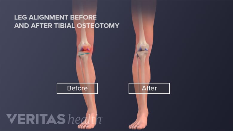 Medical illustartion showing the leg alignment before and after a tibial osteotomy surgery. After the surgery there is less bowness in the lower leg.