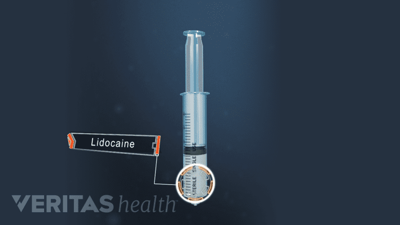 Syringe full of lidocaine.
