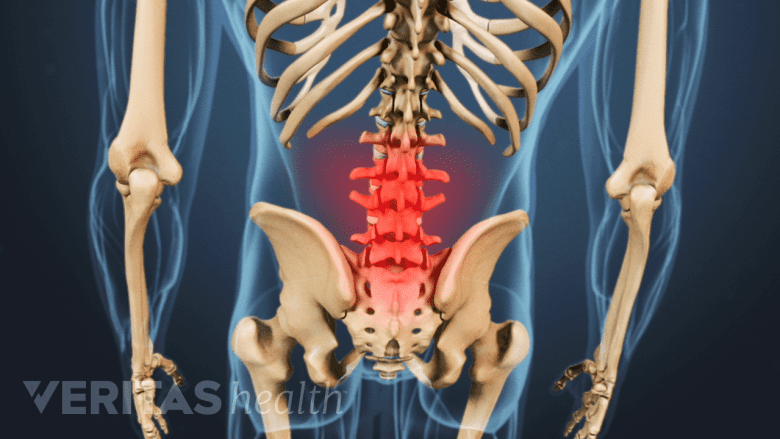Medical illustration of the spine. The lumbar area is highlighted in red to indicate pain, numbness or tingling.