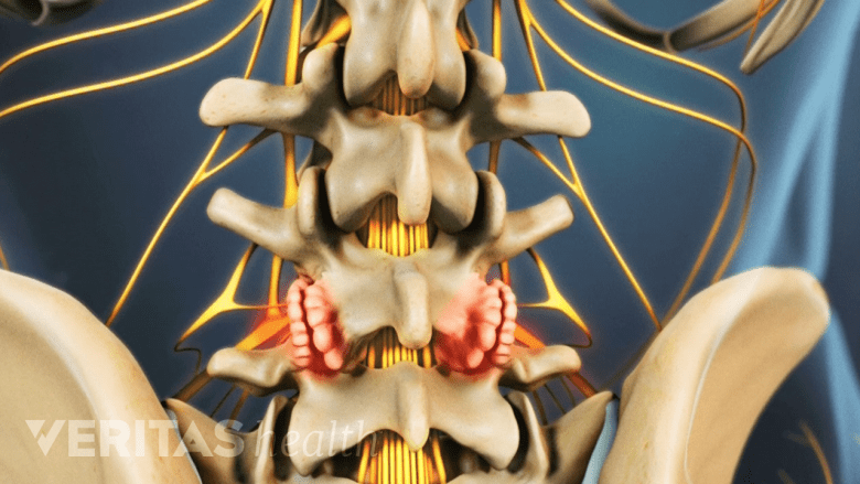 An illustration showing osteoarthritis of the lumbar spine.