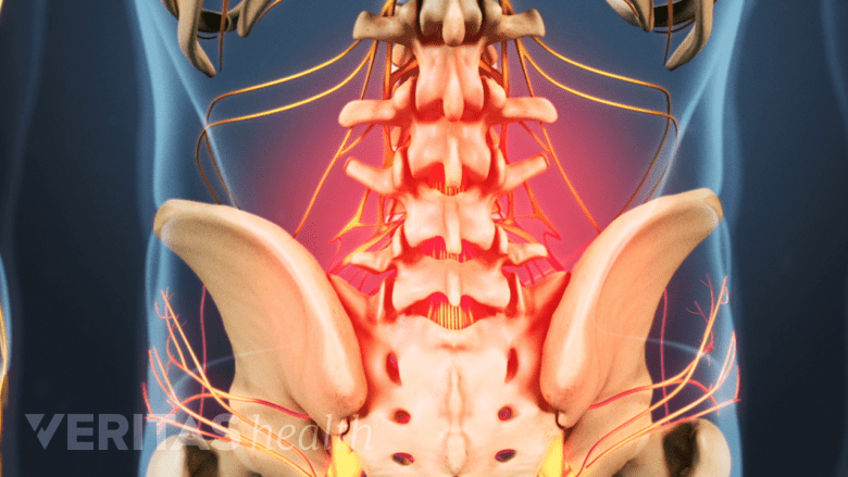 Illustration showing lower back pain highlighted in red.