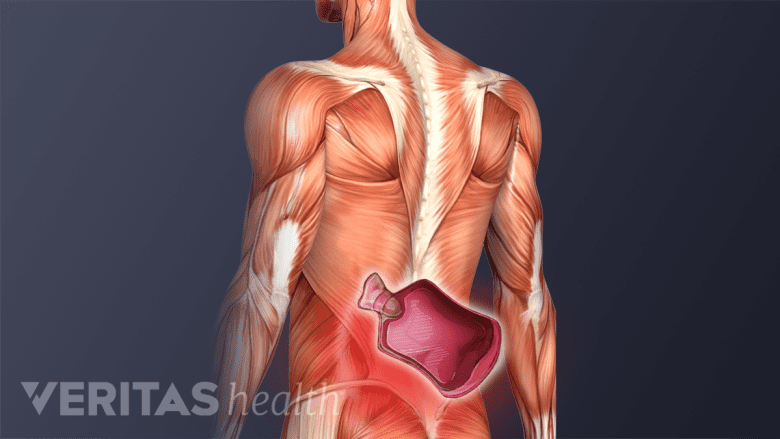 Illlustration showing posterior view of back muscles with a red highlight and an heat pack icon in the lower back.