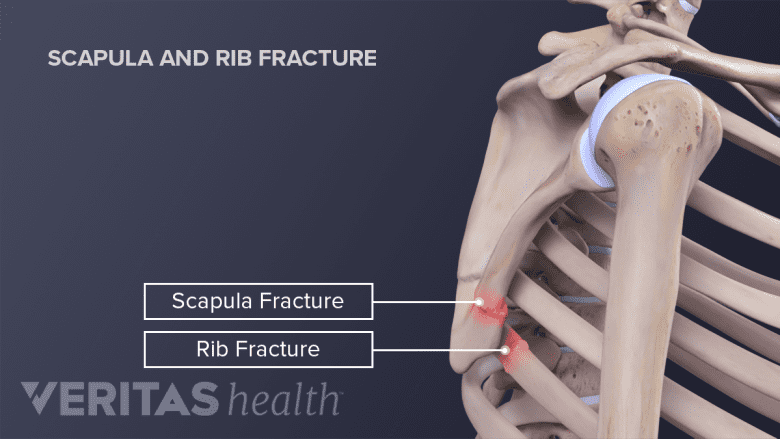 Shoulder blade or scapula fracture and rib fracture occurring together
