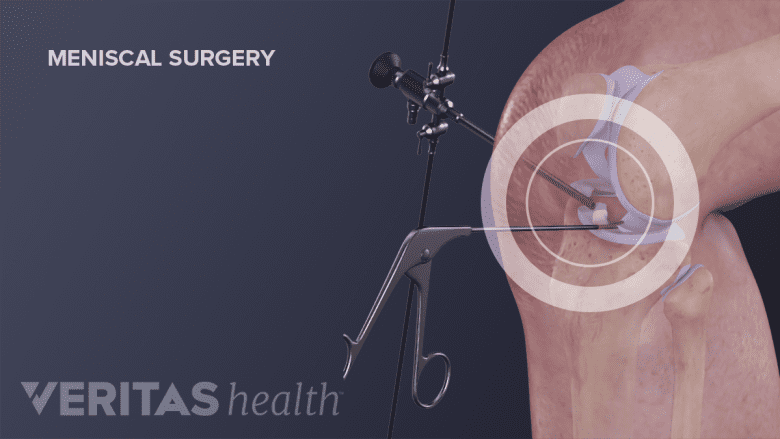 Instrumentation used in knee meniscal surgery