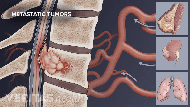 Metastatic cancer cells spreading to the spine from the breast, kidney, and lung.