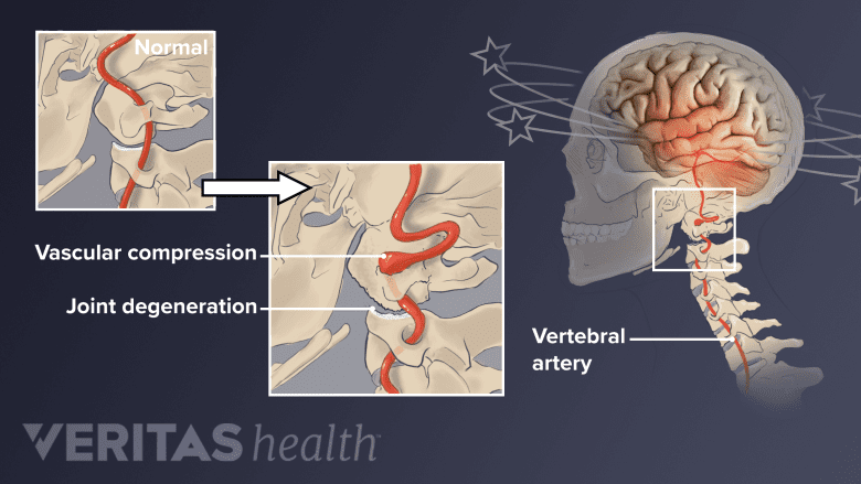 Normal and compressed vertebral artery in the neck.