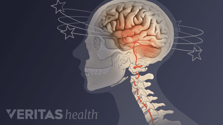 Illustration of skeleton head and neck indicating dizziness.