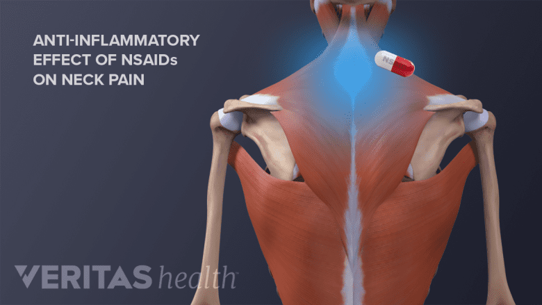 tirzepatide stiff neck How to Treat Chronic Stiff Neck and Headache Explained