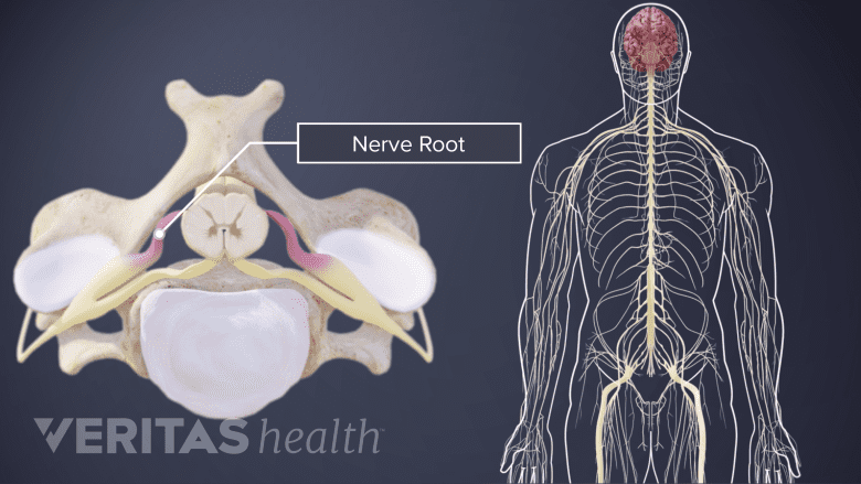 Top down view of cervical vertebrae with nerve root labeled, next to diagram of body nerves.