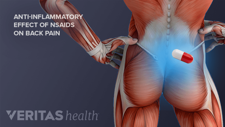 Effect of NSAID on lower back pain.