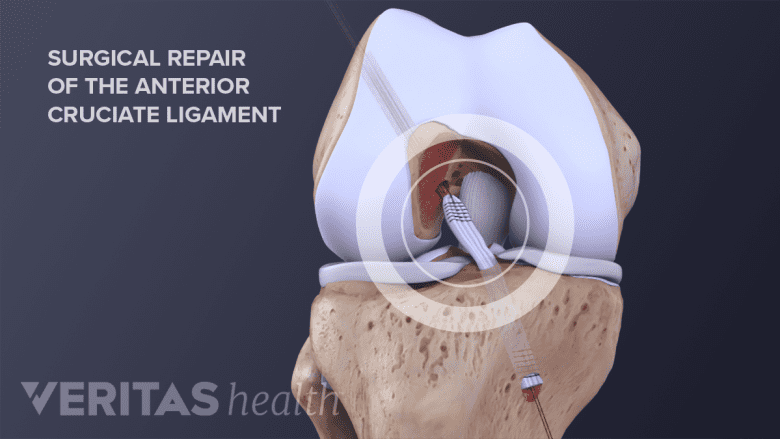 Patellar tendon graft placed during ACL repair surgery