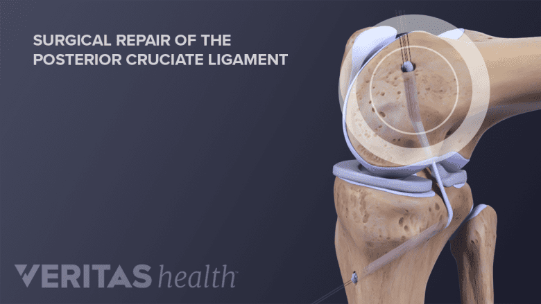 Illustration of knee anatomy showing PCL graft.