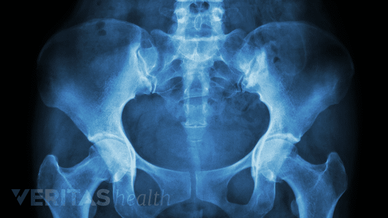 X-ray image of pelvis and lower spine.