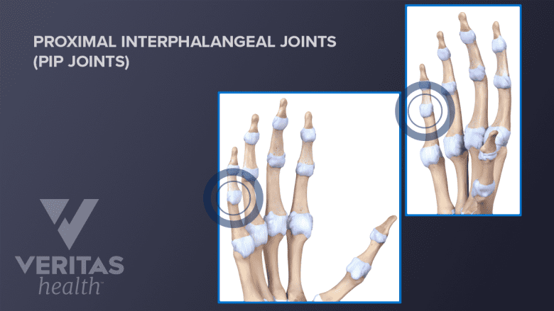 Illustration of PIP joint of the hand