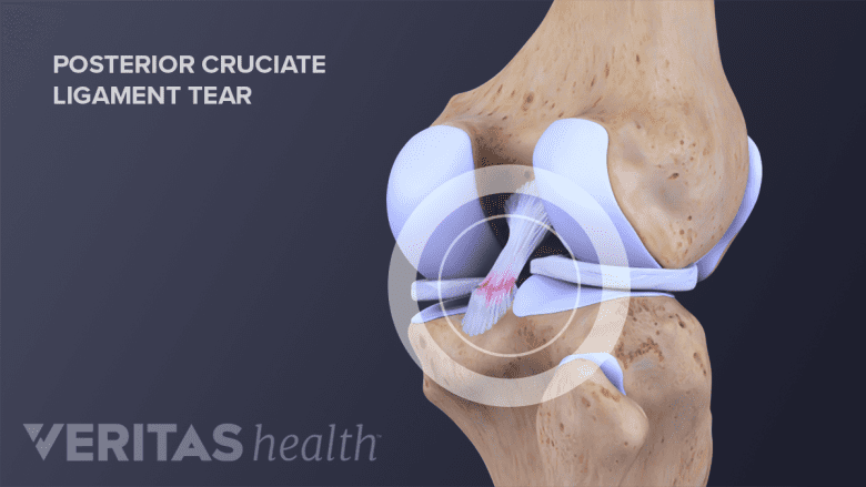 Illustration showing torn PCL.