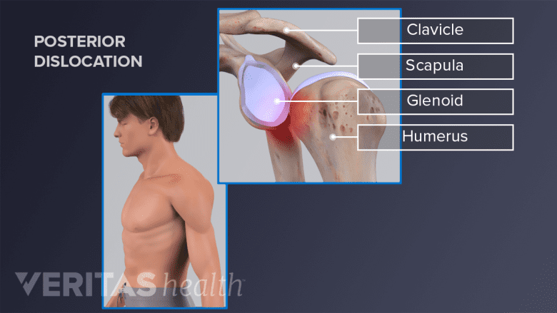 Illustration showing a man with posterior dislocation and an inset showing anatomy of dislocated shoulder joint.