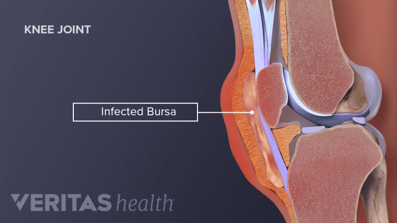 Illustration showing knee anatomy labelling inflamed bursa.