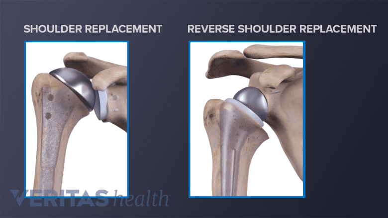 Total shoulder replacement vs reverse shoulder replacement
