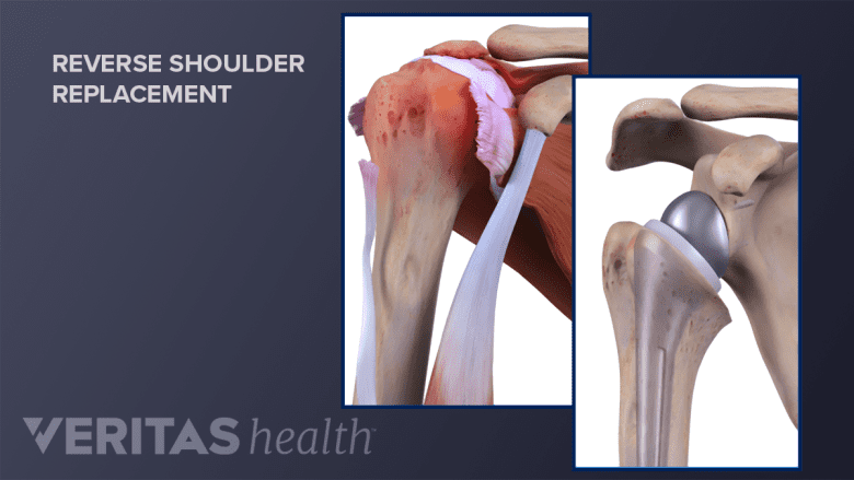 Reverse shoulder replacement procedure.