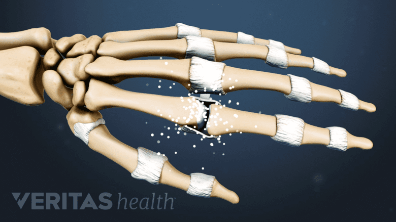 Medical illustration showing phase 1 of rhematoid arthritis in the hand