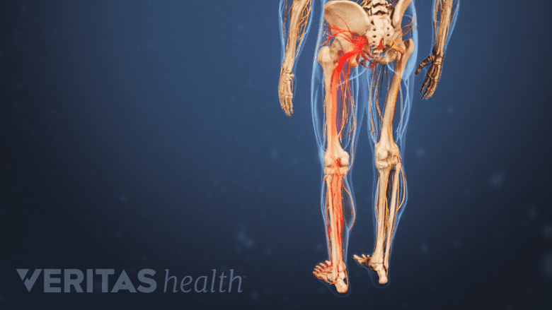 nerve pain in the left leg.
