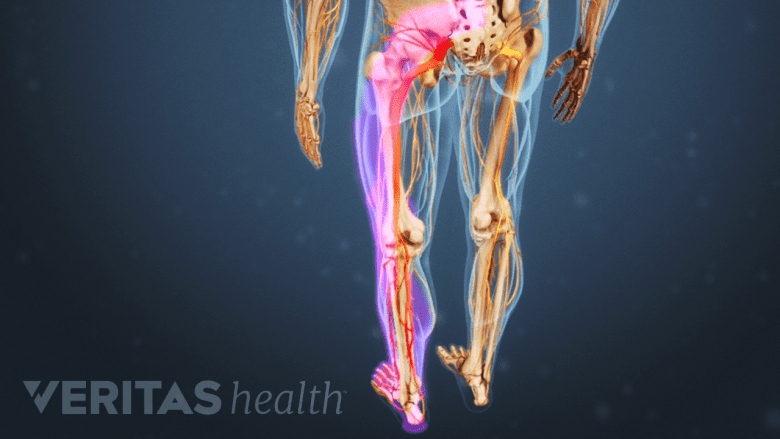 Nerve pain in the left leg.