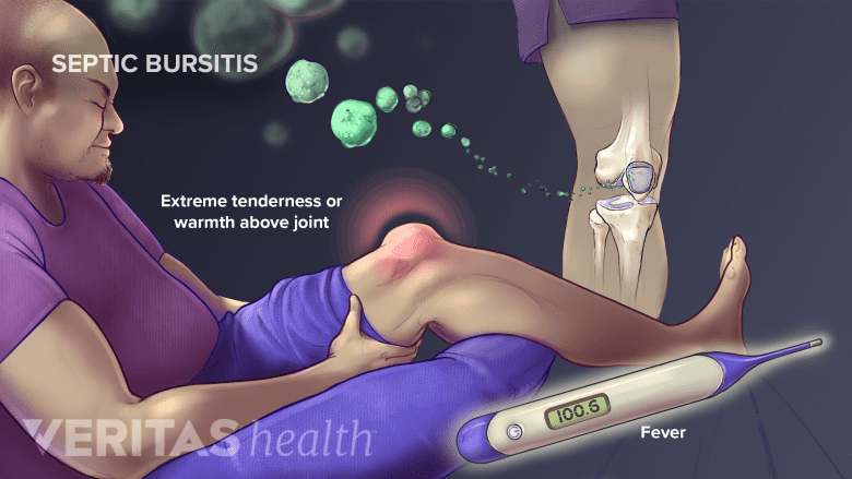 A man experiencing septic bursitis.