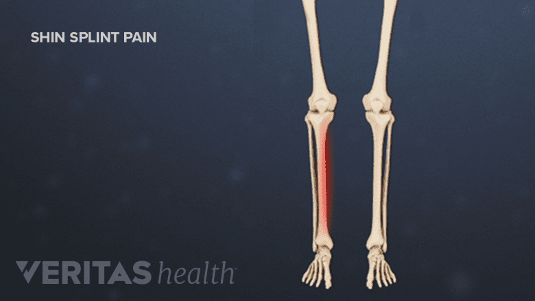 Illustration showing shin splint pain.