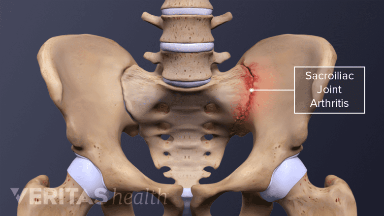 illustration of SI joint arthritis on the left side of the pelvis.