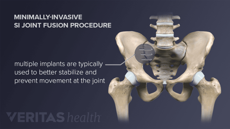 Hip and pelvis, with a metal implant connecting the SI joint.
