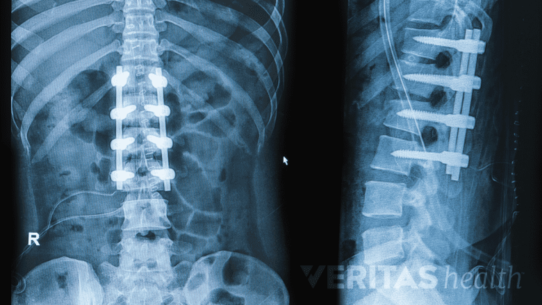 Illustration showing x-ray of lumbar spinal fusion with fused segment
