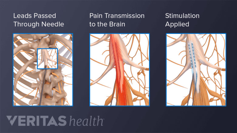 Electric signals passing through spinal cord stimulator wires.