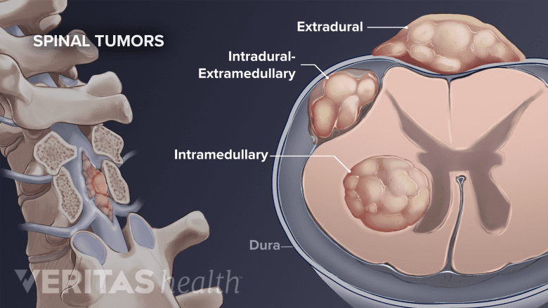 3 types of tumors originating in the spine.