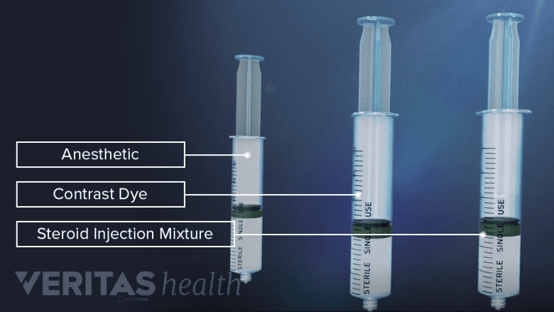 An illustration showing components of steroid injection.