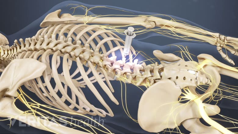 Injection in the spine.