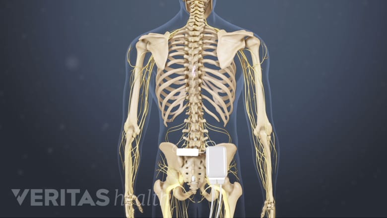 Spinal cord stimulator implant in the lower back.