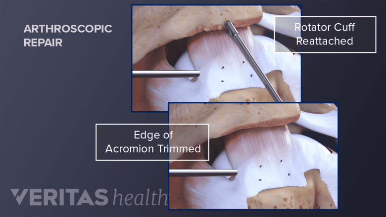 Illustration showing arthroscopic rotator cuff repair surgery.