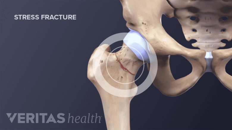 Illustration of anatomy of hip bone showing stress fracture.