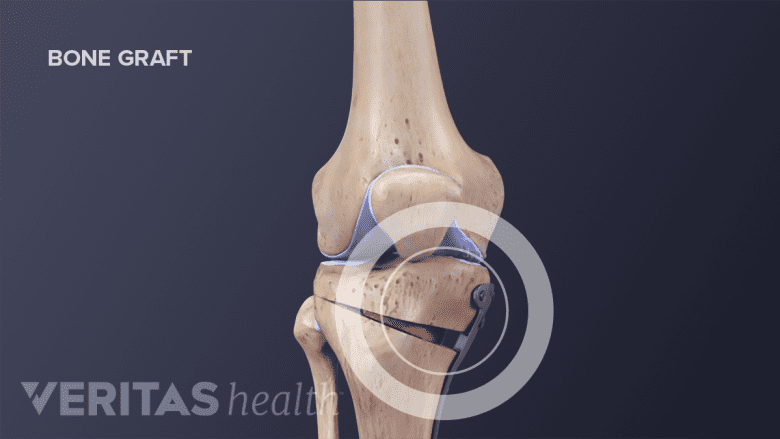Medical illustration showing parts of the bone that are removed during a tibial osteotomy.