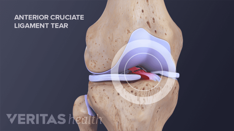 Anterior view of a torn anterior cruciate ligament (ACL) of the knee