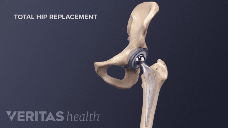Total hip replacement surgery.