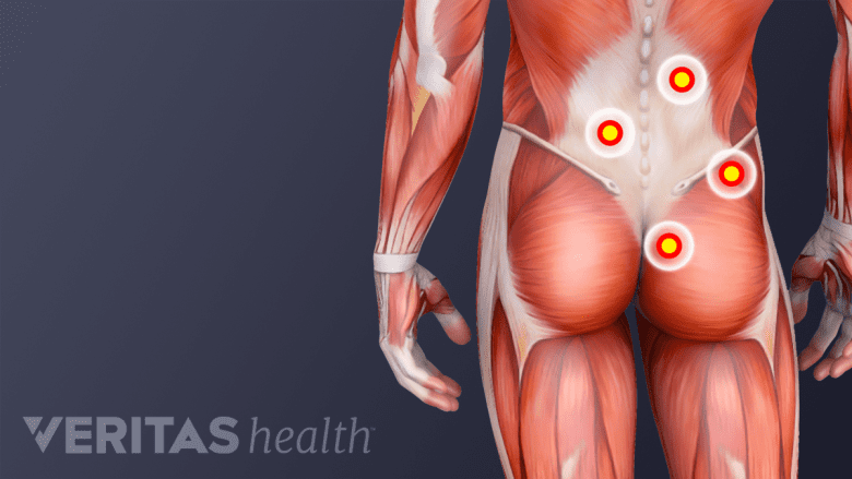 An image showing trigger points in lower back.