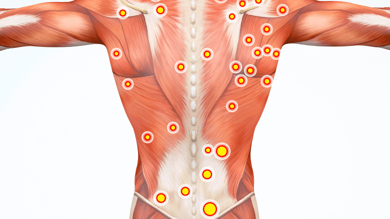 Trigger points in the muscles of the back.