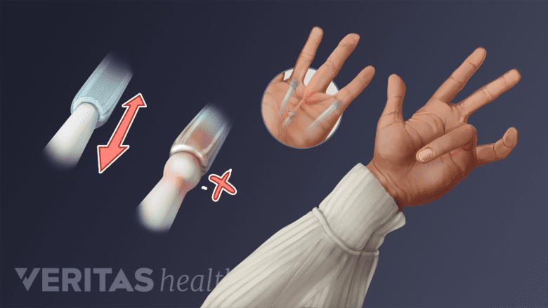 Illustration of tendon sheath inflammation and a hand with trigger finger